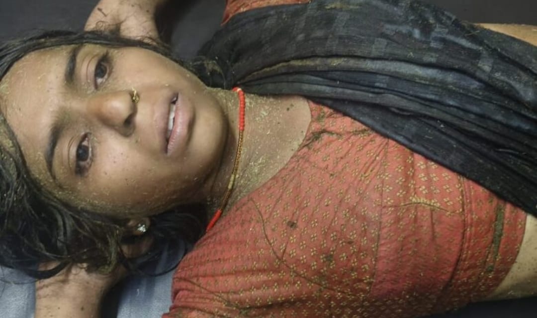बरियातू में वज्रपात से दो महिला समेत तीन घायल: दो की हालत गंभीर